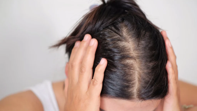 Penyebab Kebotakan Pada Rambut di Usia Muda yang Perlu Diwaspadai